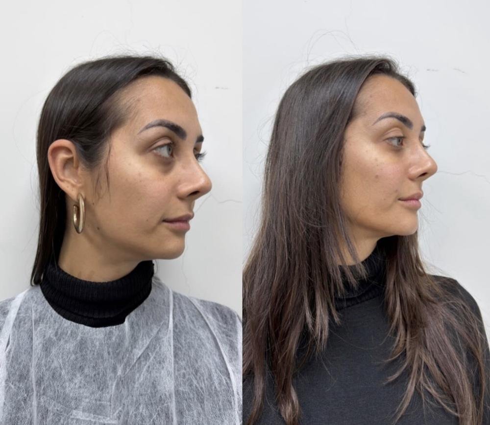 Perfil facial – antes e depois