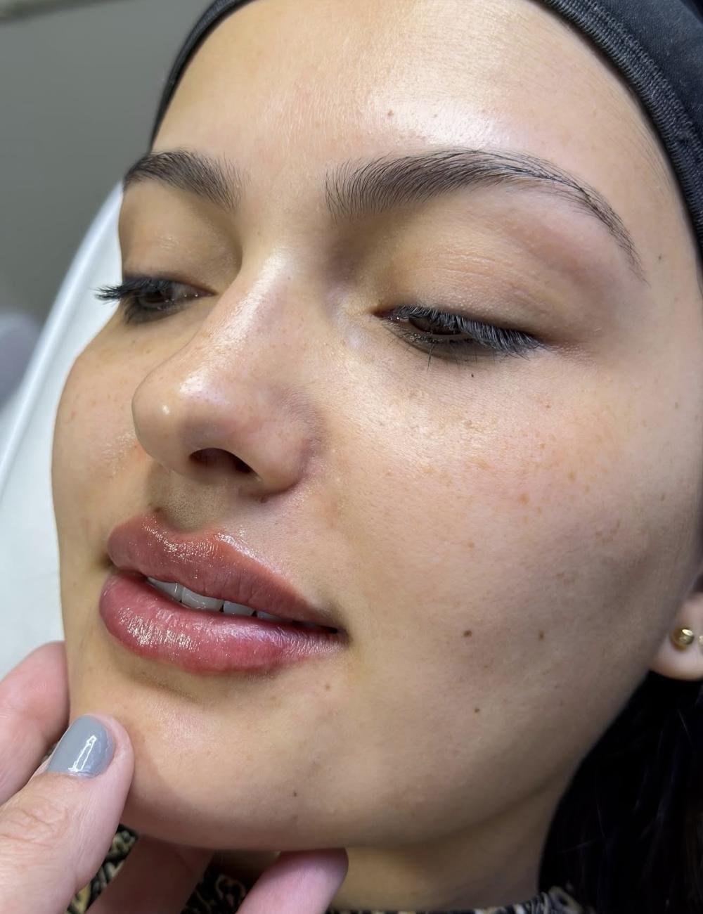 Preenchimento labial – antes e depois