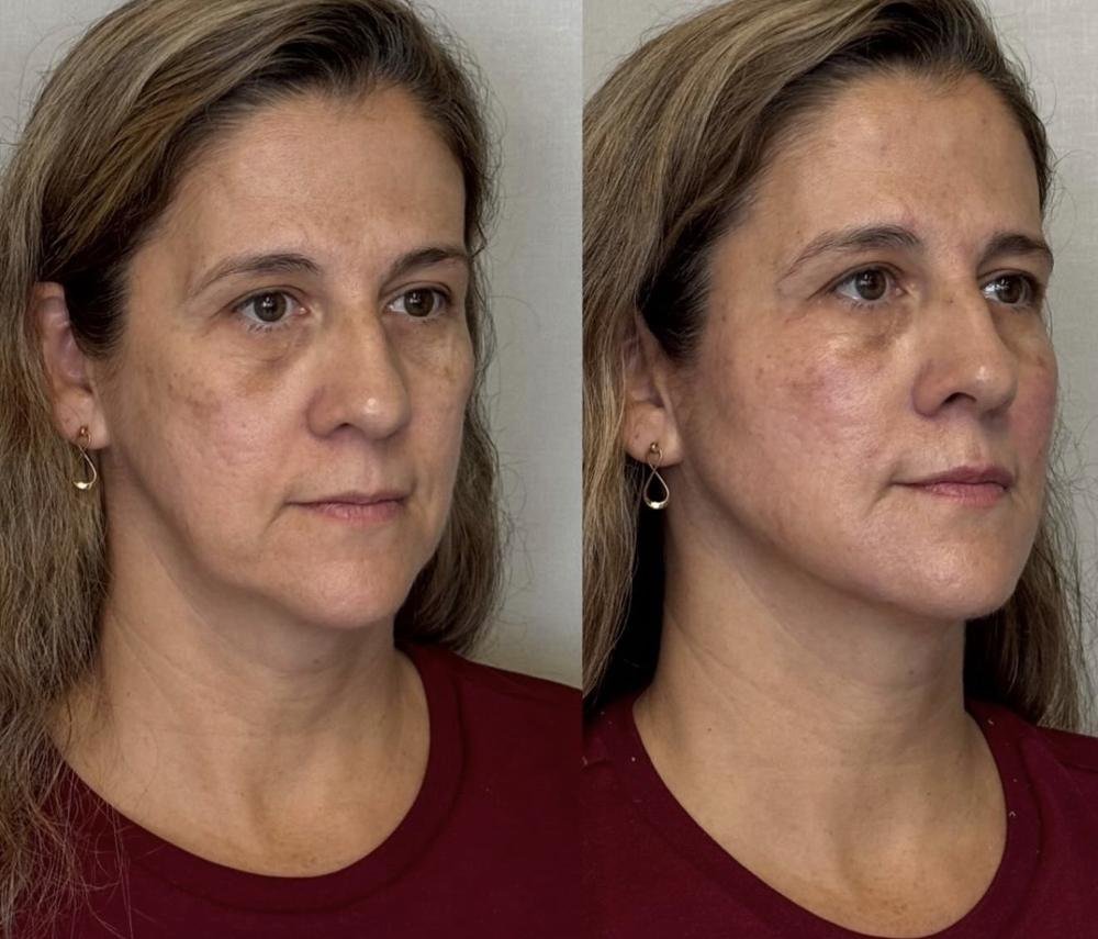 Rejuvenescimento facial – antes e depois