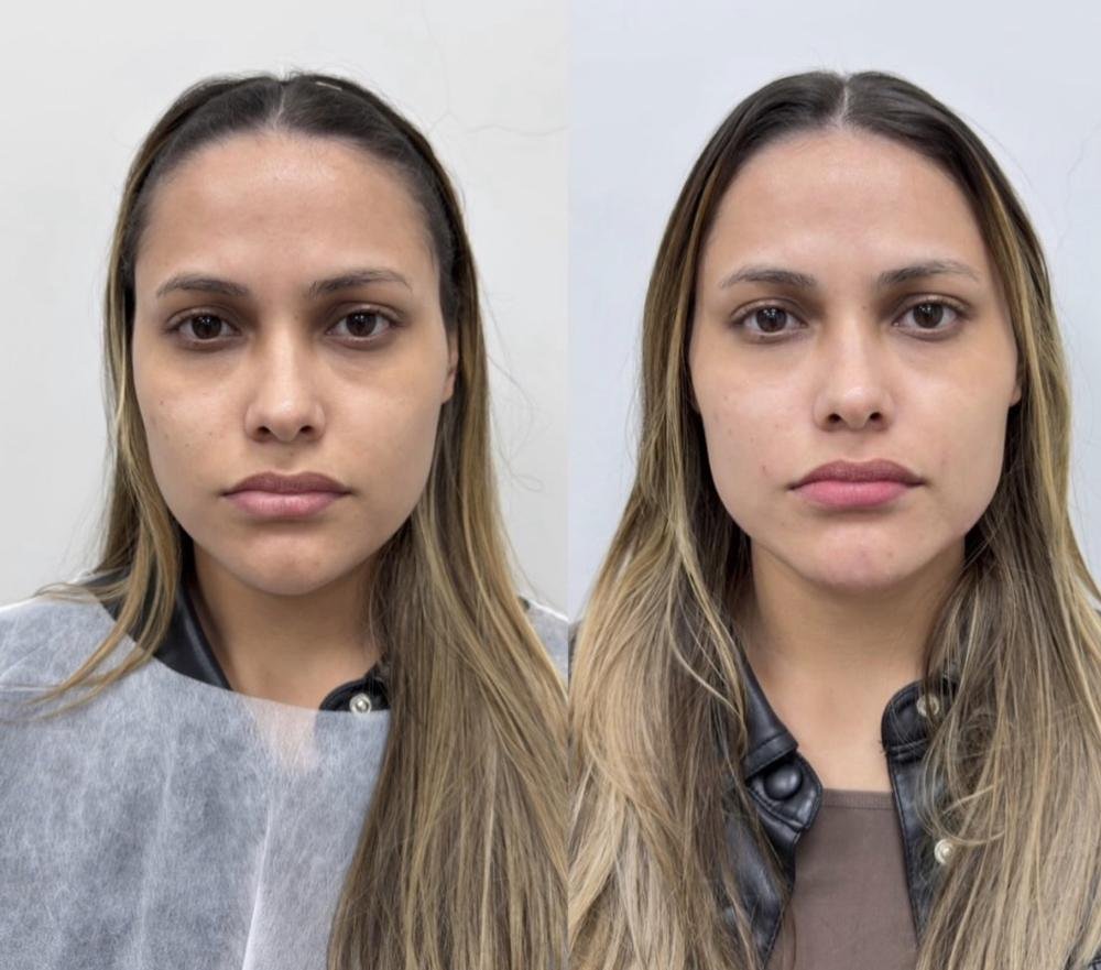 Harmonização facial – antes e depois
