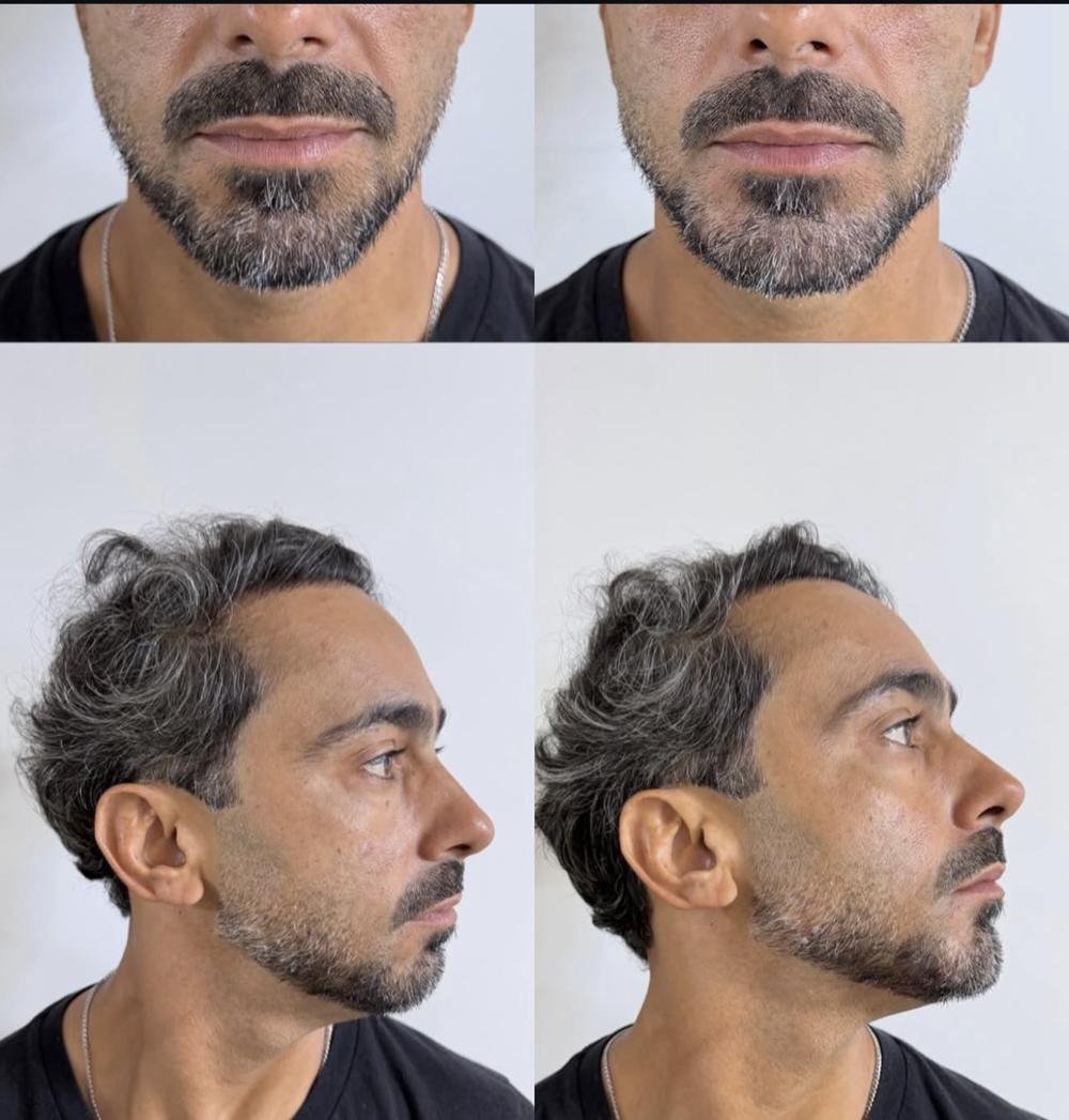 Harmonização masculina – antes e depois